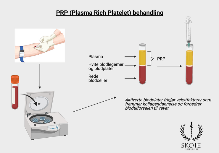 hvordan prp behandling fungerer